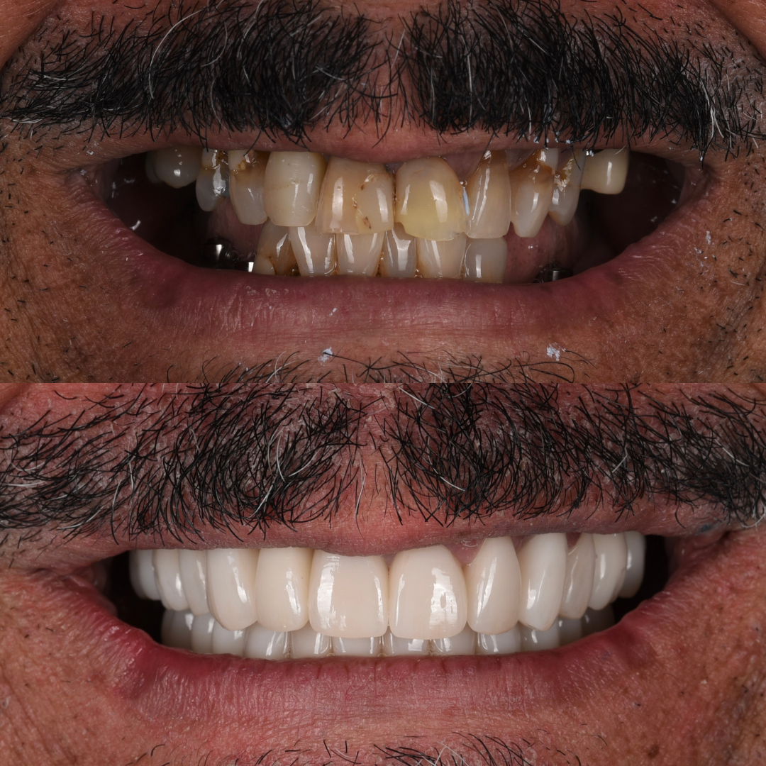 FMR SMILE MAKEOVER (2)