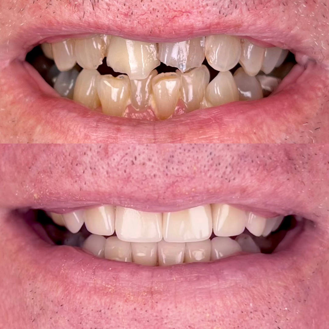 FMR SMILE MAKEOVER (3)