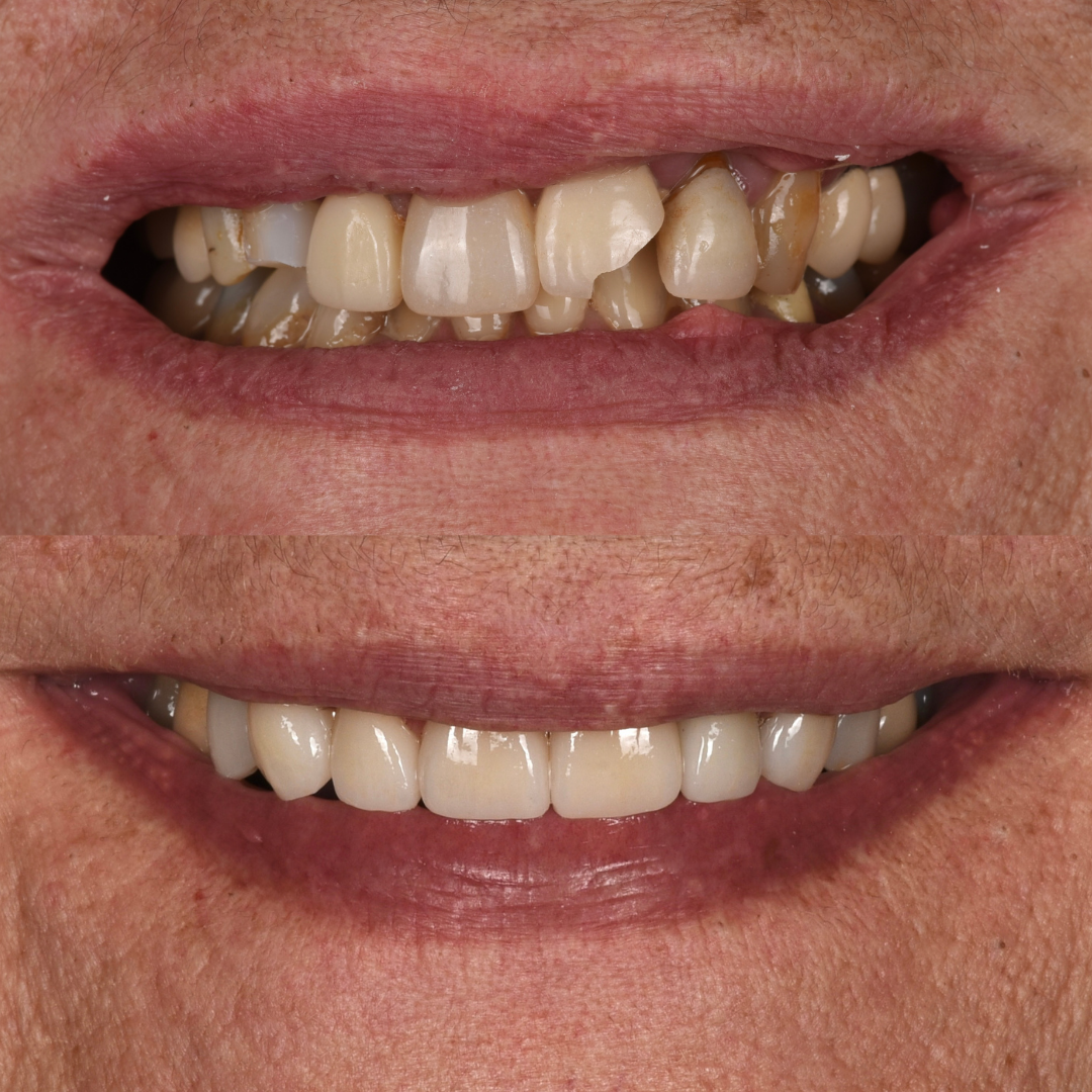 FMR SMILE MAKEOVER (4)