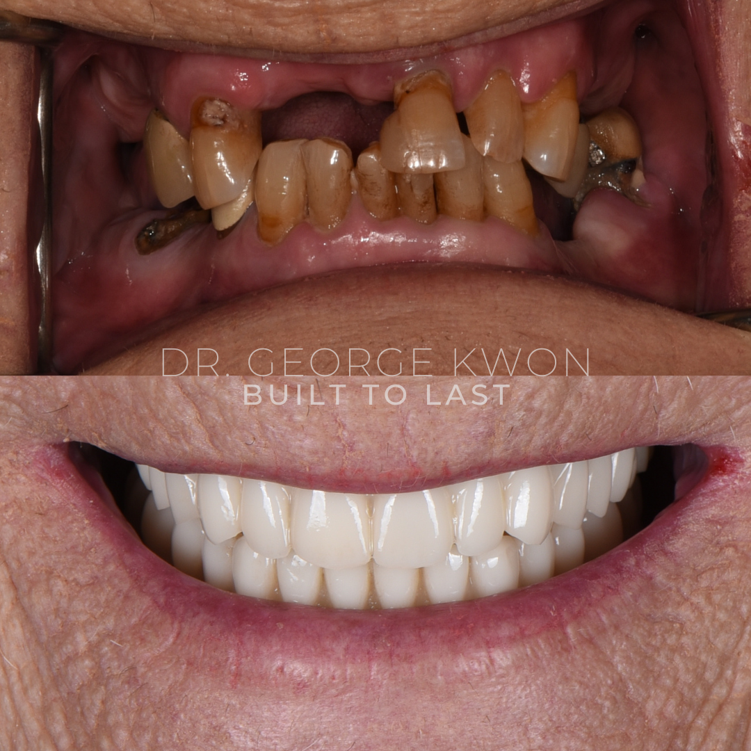 AOX FULL MOUTH BEFORE